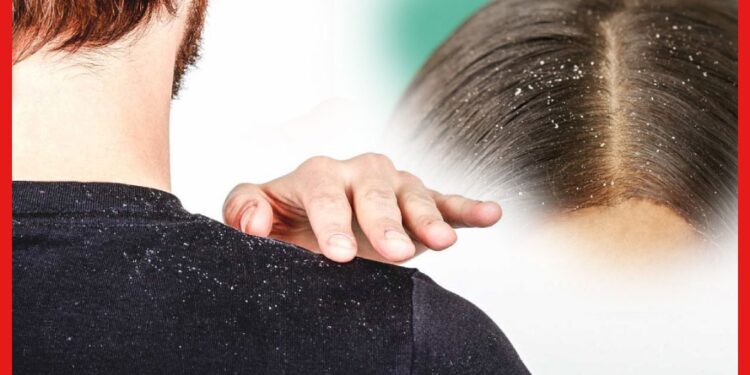 Hair Care Tips : শীতকালে খুশকির সমস্যায় ভুগছেন খুব? রইল কিছু ঘরোয়া টিপস