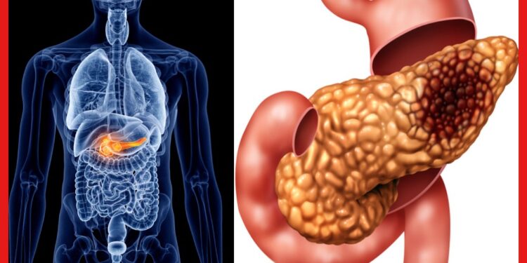 Pancreatic cancer: অগ্ন্যাশয়ের ক্যান্সার চিহ্নিত করা যায় না সহজে, উপসর্গগুলি জেনে নিয়ে থাকুন সতর্ক