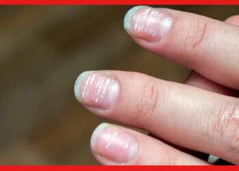 White spots on nails: এড়িয়ে যাচ্ছেন নখের সাদা দাগ! শরীরে লুকিয়ে ভয়ঙ্কর রোগ