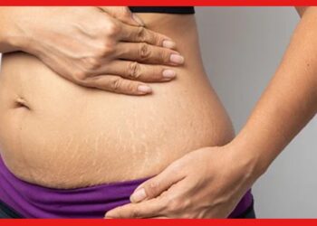 Remedies for Stretch Mark : ওষুধ কিংবা ক্রিম-লোশন নয়, প্রেগনেন্সির স্ট্রেচমার্ক কমবে ঘরোয়া টোটকায়