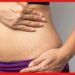 Remedies for Stretch Mark : ওষুধ কিংবা ক্রিম-লোশন নয়, প্রেগনেন্সির স্ট্রেচমার্ক কমবে ঘরোয়া টোটকায়