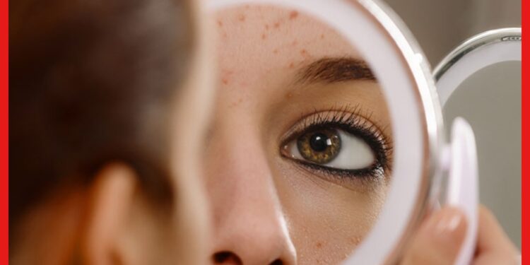 Acne Myth: অ্যাকনে মিথ কী জানেন? এটাই তো ক্ষতি করছে আপনার স্কিনের