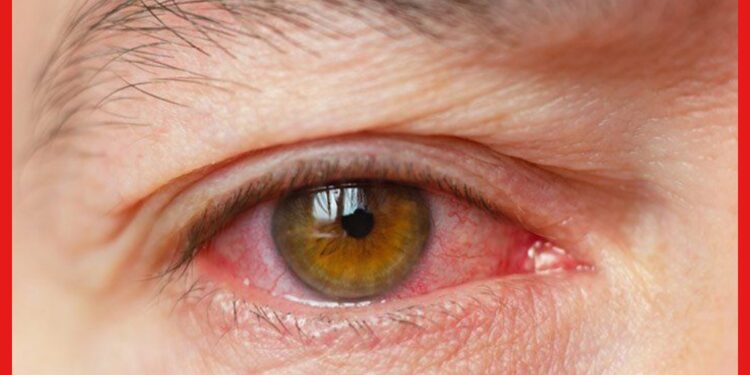 Dry Eye : চোখ জ্বলছে, দেখা দিচ্ছে লালচে ভাব ? হতে পারে ড্রাই আইয়ের সমস্যা