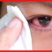 Eye care: ঠান্ডায় চোখ লাল? ভালো থাকতে এই নিয়মগুলি মেনে চলুন