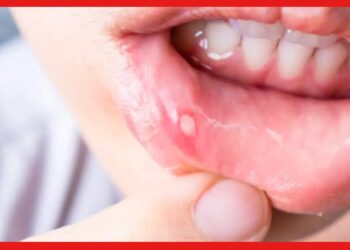Mouth ulcer: শীত পড়তে মুখের আলসার জ্বালাচ্ছে আপনাকে? এই ঘরোয়া উপায়গুলি অনুসরণ করুন