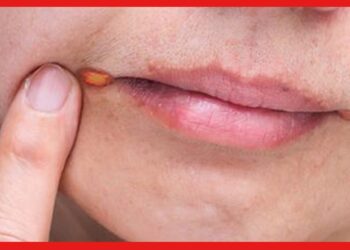 Mouth Ulcer: ঠোঁটের কোণে উঁকি মারছে দগদগে ঘা! ঘরোয়া উপায়েই সারিয়ে ফেলুন