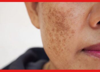 Pigmentation: মুখের কালচে দাগছোপ নিয়ে চিন্তায় ? ভরসা রাখুন আয়ুর্বেদে