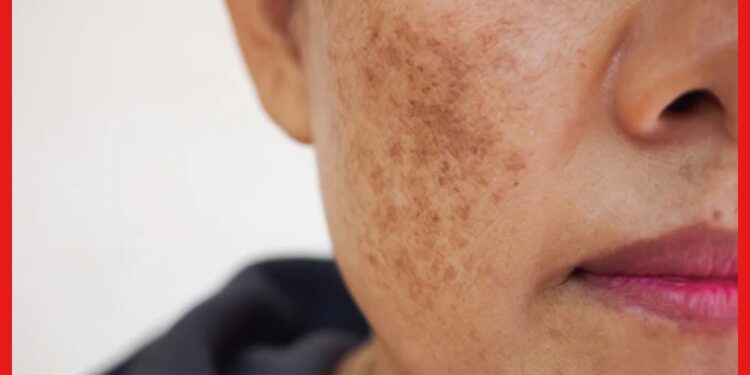 Pigmentation: মুখের কালচে দাগছোপ নিয়ে চিন্তায় ? ভরসা রাখুন আয়ুর্বেদে