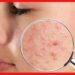 Pimple treatment: অস্বস্তিতে ভোগাচ্ছে ব্রণ? এই ঘরোয়া পদ্ধতিগুলি ম্যাজিকের মত কাজ করবে