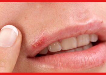 Cold Sore : শীত আসতেই ঠোঁটের কোণে উঁকি দিয়েছে ঘা ? ঘরোয়া উপায়ে মুক্তি পান জ্বরঠোসা থেকে