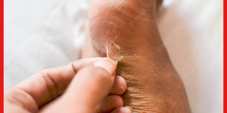 Skin Peels Off: শীতে উঠছে হাতে-পায়ের চামড়া ? আর্দ্রতার অভাব নাকি অসুখের লক্ষণ