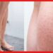 Strawberry Legs: পায়ে বেড়েই চলেছে বিন্দু বিন্দু কালো দাগ, কীভাবে মুক্তি পাবেন স্ট্রবেরি লেগ থেকে ?