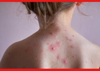 Chicken Pox: চিকেন পক্স হলে থাকুন কড়া নিয়মে, ত্বকের দাগ আটকান বাড়িতেই