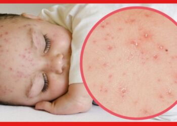 Chicken Pox: চিকেন পক্সকে ‘মায়ের দয়া’ বলার কারণ কী? কোন কাহিনী জড়িয়ে রয়েছে এর সঙ্গে?