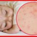 Chicken Pox: চিকেন পক্সকে ‘মায়ের দয়া’ বলার কারণ কী? কোন কাহিনী জড়িয়ে রয়েছে এর সঙ্গে?