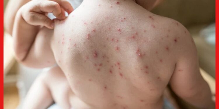 Chicken Pox: চিকেন পক্স হলে কী কী সাবধানতা অবলম্বন করবেন ? ডায়েট চার্টই বা হবে কেমন