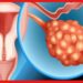 Ovarian Cyst Problem: বেশিরভাগ মেয়েদের ওভারিতে সিস্ট, সন্তান ধারণে অসুবিধা! লক্ষণ দেখে এখনই সাবধান হন