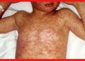 Measles: বসন্তে হাম থেকে সাবধান থাকবে কীভাবে? এই রোগের লক্ষণ কী?