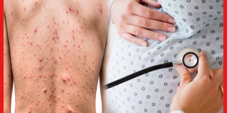 Chicken Pox : গর্ভবতী মায়েদের জন্য মারাত্মক চিকেন পক্স! সংক্রমনের ভয় বেশি কাদের ?