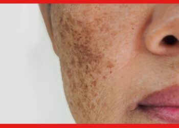 Pigmentation : কোথাও কালচে কোথাও ফ্যাকাসে মুখের ত্বক! পিগমেন্টেশনের সমস্যা পিছু ছাড়বে কীভাবে?
