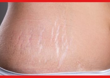 Stretch marks: স্ট্রেচ মার্কসের জন্য খোলামেলা পোশাক পড়তে লজ্জা! ৩ টে টোটকায় ম্যাজিক দেখুন