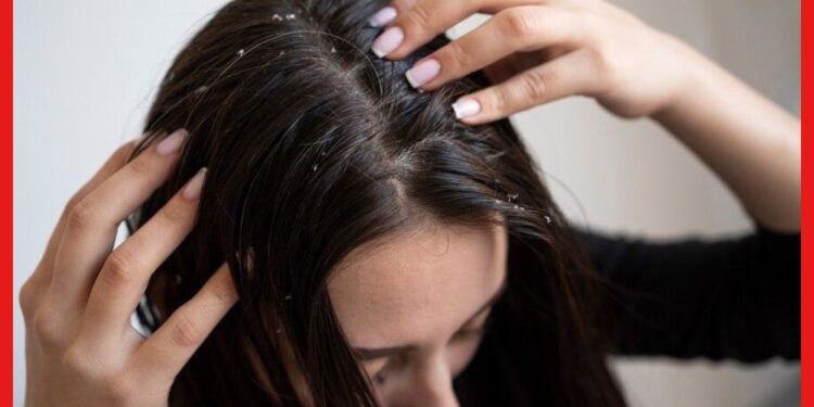 Dandruff Home Remedies: খুশকিতে চুল ঝরে যাচ্ছে? ৭ দিন এই টোটকা মানুন, খুশকি থেকে মুক্তি