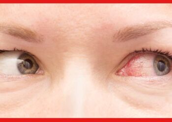 Conjunctivitis Treatment: বর্ষায় ঘরে ঘরে চোখ উঠছে, আতঙ্কিত না হয়ে জেনে নিন এই রোগের প্রতিকার ও করণীয়