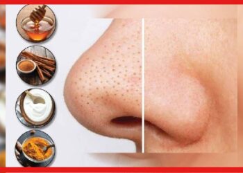 Blackheads Removal at Home: বিয়ের আগে নাকের দুপাশে ভরে যাচ্ছে ব্ল্যাকহেডস? এই ৪ সহজ উপায়ে ব্ল্যাকহেডস রিমুভ করুন