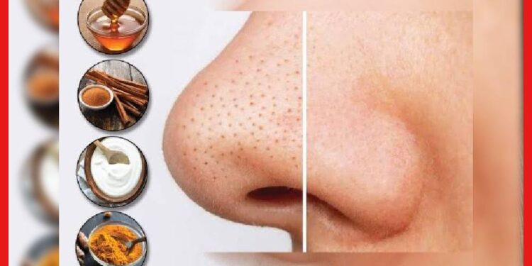 Blackheads Removal at Home: বিয়ের আগে নাকের দুপাশে ভরে যাচ্ছে ব্ল্যাকহেডস? এই ৪ সহজ উপায়ে ব্ল্যাকহেডস রিমুভ করুন
