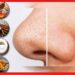 Blackheads Removal at Home: বিয়ের আগে নাকের দুপাশে ভরে যাচ্ছে ব্ল্যাকহেডস? এই ৪ সহজ উপায়ে ব্ল্যাকহেডস রিমুভ করুন