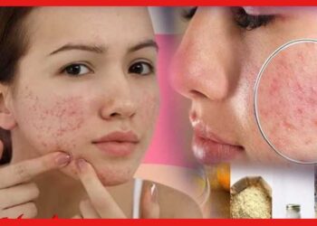 How To Reduce Pimple Mark:  ব্রণর দাগ-গর্ত কমাবেন কীভাবে ? ৭ দিন এই টিপস মানুন, আপনার গালের গর্ত ভরাট হবেই