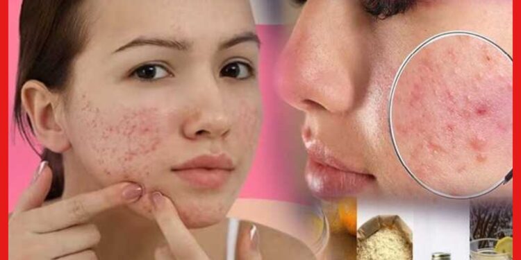 How To Reduce Pimple Mark: ব্রণর দাগ-গর্ত কমাবেন কীভাবে ? ৭ দিন এই টিপস মানুন, আপনার গালের গর্ত ভরাট হবেই