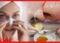Blackheads: পার্লারে যাওয়ার দরকার নেই, ঘরে বসেই তুলে ফেলুন ব্ল্যাক হেডস, কিভাবে?