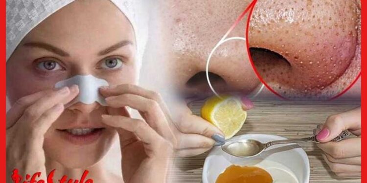 Blackheads: পার্লারে যাওয়ার দরকার নেই, ঘরে বসেই তুলে ফেলুন ব্ল্যাক হেডস, কিভাবে?
