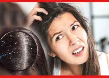 Dandruff Remedies: মাথায় হাত দিলেই খুশকি ঝরে ঝরে পড়ছে ? ঘরোয়া উপায়ে খুশকি কে চিরবিদাই দিন আজই