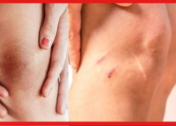 Scars Remove: হাঁটুর কাটা দাগ নিয়ে ছোট ড্রেস পরতে লজ্জা? পুজোর আগে এই টোটকাতেই হবে দারুন কাজ