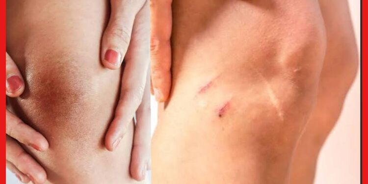 Scars Remove: হাঁটুর কাটা দাগ নিয়ে ছোট ড্রেস পরতে লজ্জা? পুজোর আগে এই টোটকাতেই হবে দারুন কাজ