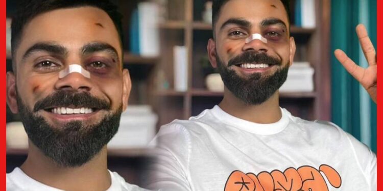 Virat Kohli: বিরাটের চোখে কালশিটে! কে বদলা নিল ? বিশ্বকাপ না জেতার ফল