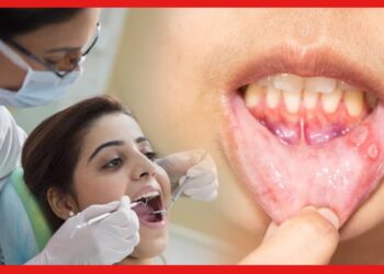 Mouth Ulcer: মুখের ঘা নিয়ে অস্বস্তি! রেহাই পেতে কি করবেন?