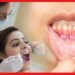 Mouth Ulcer: মুখের ঘা নিয়ে অস্বস্তি! রেহাই পেতে কি করবেন?