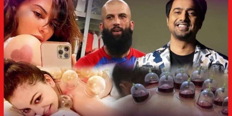 Cupping Therapy Benefits: বলিউড থেকে টলিউড ভরসা রাখছেন কাপিং থেরাপিতে, কি এই থেরাপি?