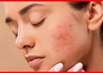 Acne Scars: ব্রণ আর ব্রণর দাগ নিয়ে জেরবার? সমাধান লুকিয়ে রয়েছে চায়ের পাতায়