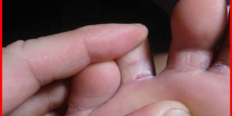 Tinea pedis: গরমে পায়ের আঙুলের ফাঁকে কে বারবার ঘা হচ্ছে? দেখে নিন সমাধানের উপায়