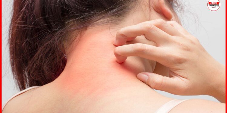 Heat rash treatment: ঘামাচির জ্বালায় নাজেহাল অবস্থা? পাওডার নয়, এই টোটকাতেই মিলবে আরাম