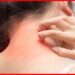 Heat rash treatment: ঘামাচির জ্বালায় নাজেহাল অবস্থা? পাওডার নয়, এই টোটকাতেই মিলবে আরাম