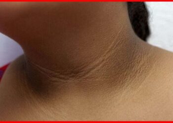 Black Neck: ঘাড়ের কালচে ত্বক লজ্জায় ফেলছে ? কিছু সহজ প্রতিকারে ঝকঝকে করে ফেলুন