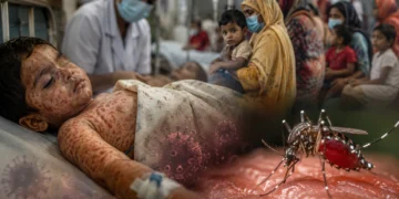 Bangladesh Measles Outbreak sees 788 confirmed and suspected deaths as dengue cases also rise