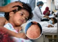 Measles Deaths in Bangladesh rise above 1,000 as three more children die